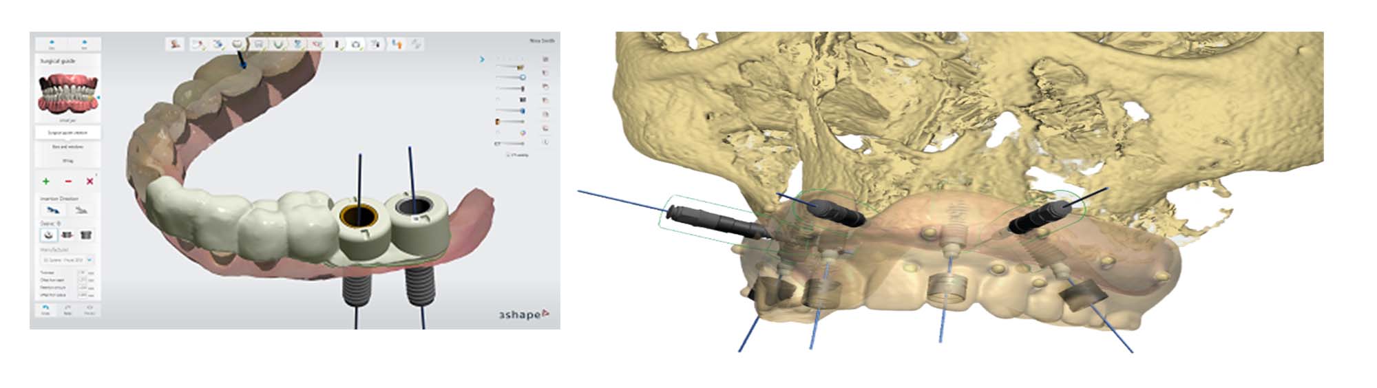 3D SURGICAL GUIDES For DENTAL IMPLANTS – DIGITAL DENTOFACIAL CONCEPTS